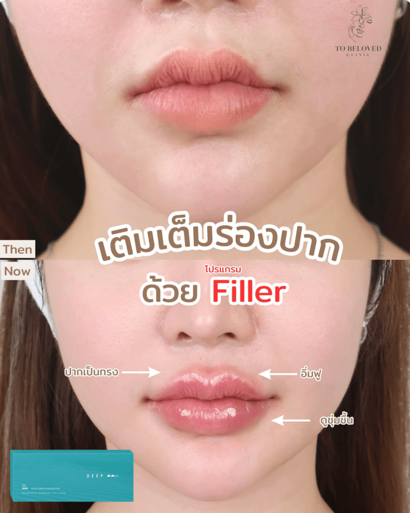 ฟิลเลอร์